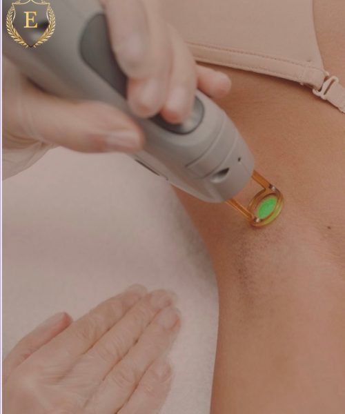 Depilación Láser Alejandrita Mujer