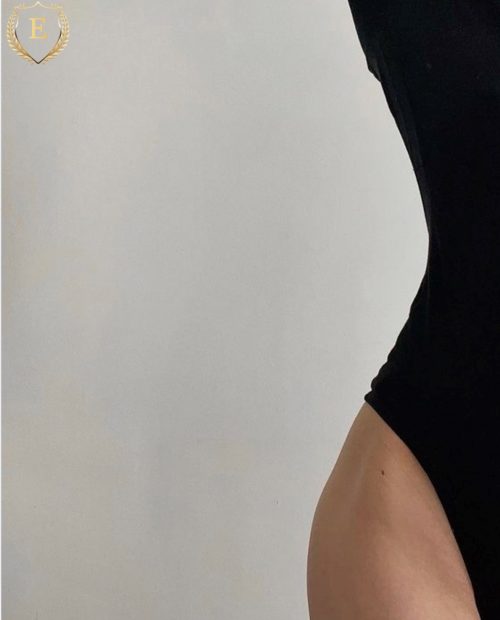 Eliminación Flacidez Corporal